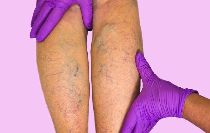 Varicose veins of the lower limbs